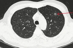 Thùy trên phổi trái có đám tổn thương kính mờ, bờ tua gai kích thước 10x13mm.