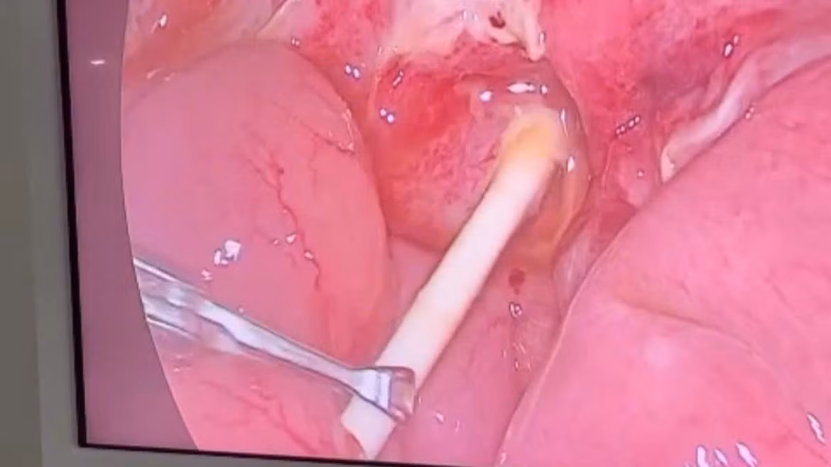Phẫu thuật nội soi lấy dị vật là que kẹo mút dài 6cm trong tá tràng bé 5 tuổi. (Ảnh do bệnh viện cung cấp)