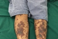 Một bệnh nhân mắc bệnh Liên câu lợn đang được điều trị tại bệnh viện. (Ảnh minh họa)