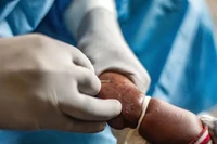 Nhân viên y tế điều trị cho em nhỏ mắc đậu mùa khỉ tại Nyiragongo, Cộng hòa Dân chủ Congo ngày 15/8/2024. (Ảnh: THX/TTXVN)
