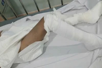 Hình ảnh cháu K. đang điều trị bỏng tại bệnh viện.