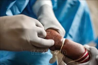 Nhân viên y tế điều trị cho trẻ em mắc đậu mùa khỉ tại Nyiragongo, Bắc Kivu, Cộng hòa Dân chủ Congo, ngày 15/8/2024. (Ảnh: THX/TTXVN)