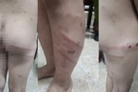 Hình ảnh cháu M. bị mẹ ruột và người tình của mẹ đánh đập gây thương tích nghiêm trọng.