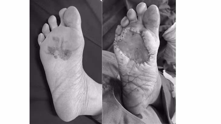 Bệnh nhân ung thư tế bào hắc tố gan chân trước và sau phẫu thuật. (Ảnh: BVCC)