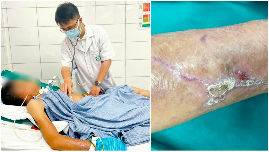 Bệnh nhân nằm điều trị tại Bệnh viện Bạch Mai do uốn ván. 