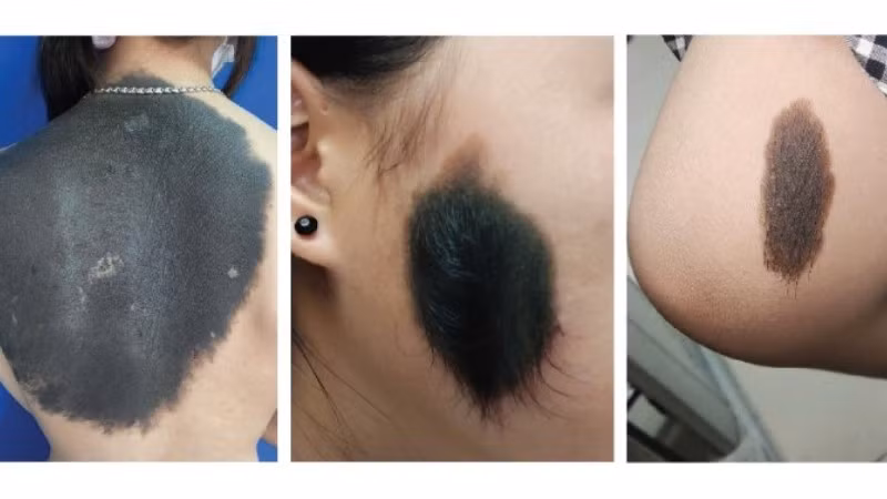 Hình ảnh nơ vi hắc tố bẩm sinh (Cơ quan y tế cung cấp).