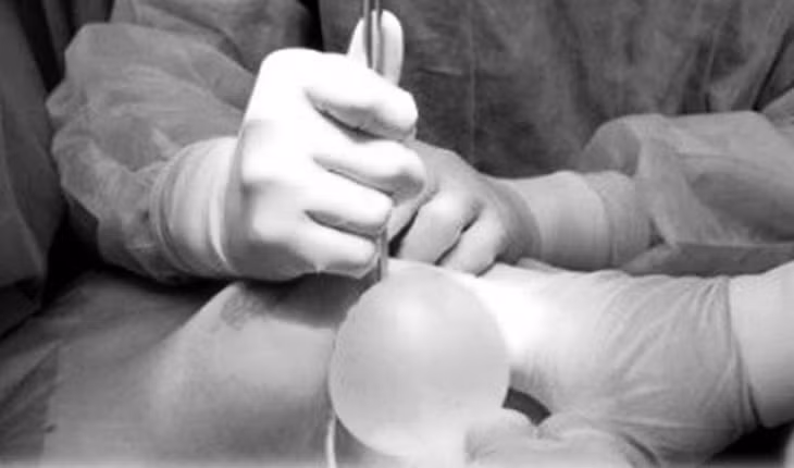 Các bác sĩ thực hiện phẫu thuật hút dịch mủ ngực cho bệnh nhân.