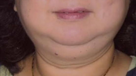 Bệnh nhân có mặt tròn, tăng cân bất thường do suy tuyến thượng thận. 