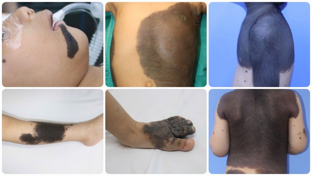 Nơ vi có thể xuất hiện ở nhiều vị trí trên cơ thể. ed374aef-44bb-4f69-a661-0cf1d45018d2-mceu-22058614411750761712214.jpg
