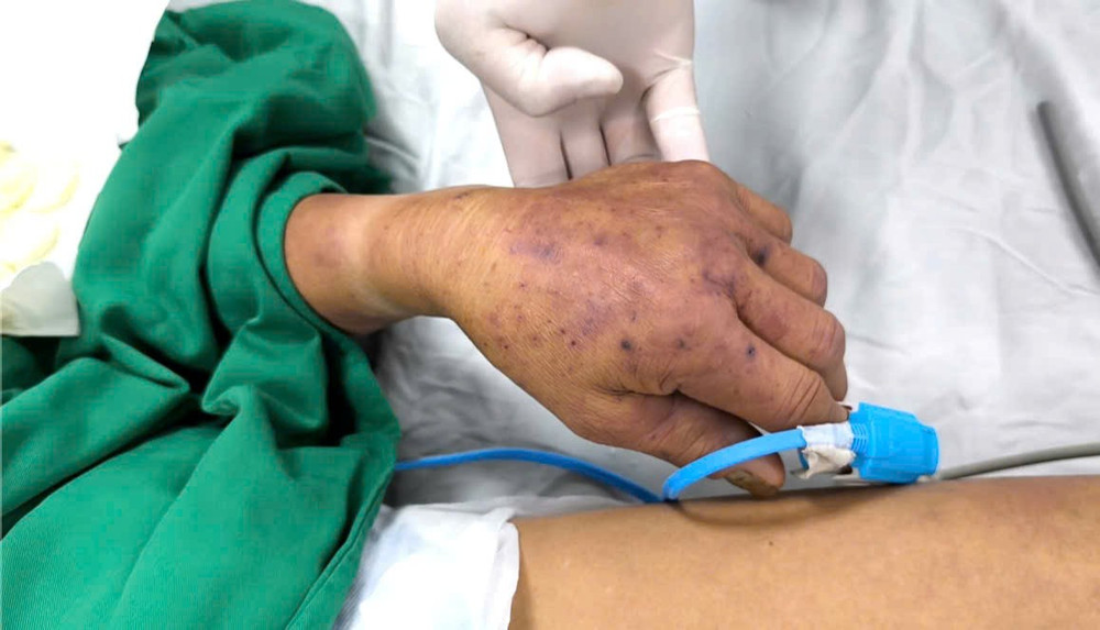 Bệnh nhân nổi ban tím tứ chi. z6787084923494-bfa4aa25086302107583fa9683c46d22.jpg