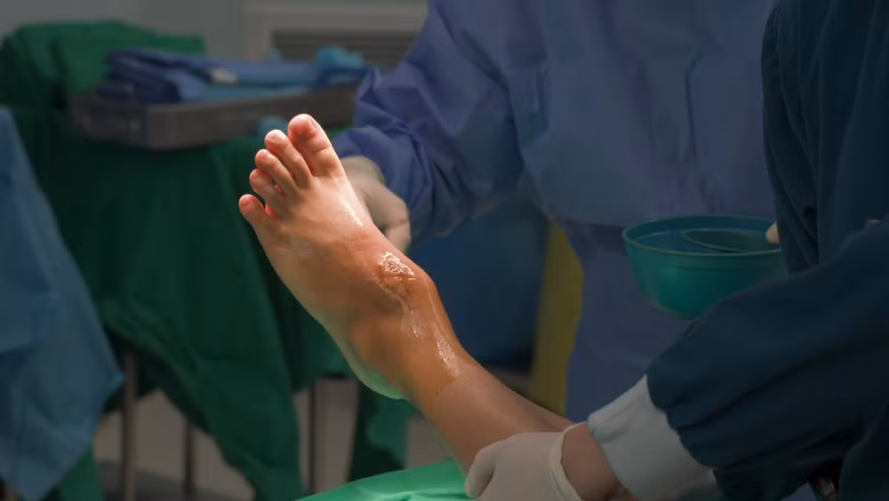 Khối u âm thầm phá hủy đến 80% thể tích xương sên của người bệnh, gây ra những cơn đau đầy ám ảnh.