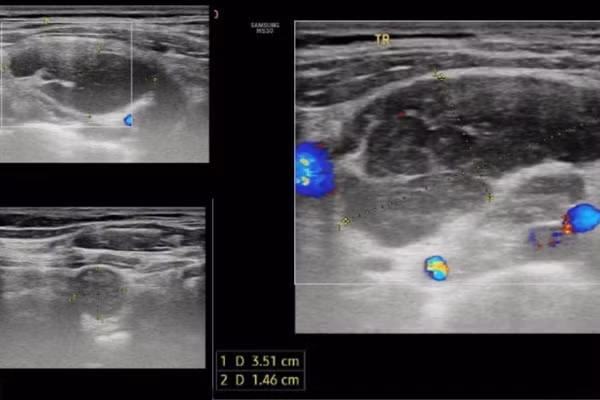 Kết quả siêu âm tuyến giáp ghi nhận hạch vùng cổ và hố thượng đòn hai bên.