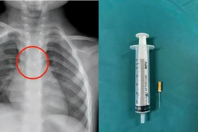 Dị vật trong đường thở của bệnh nhi. (Ảnh: Bệnh viện Đa khoa tỉnh Quảng Trị)