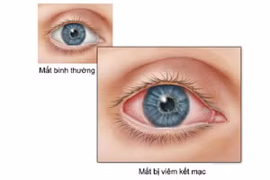 Viêm kết mạc là một trong những biểu hiện của người bệnh dương tính với Covid-19.