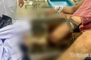 Nạn nhân bị tai nạn lao động nghiêm trọng do bất cẩn khi sử dụng máy xay thịt.