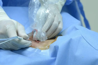 Theo các bác sĩ Bệnh viện Nội tiết Trung ương, kỹ thuật đốt sóng cao tần là một giải pháp đột phá, mang lại hiệu quả cao, an toàn và ít xâm lấn.