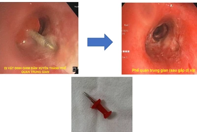 Hình ảnh nội soi ống mềm gắp dị vật đinh ghim xuyên thành phế quản trung gian.