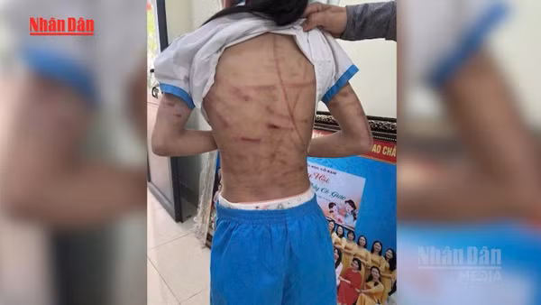 [Video] Bộ Y tế đề nghị lập đường dây nóng 24/7, xử nghiêm mọi hành vi che giấu bạo hành trẻ em