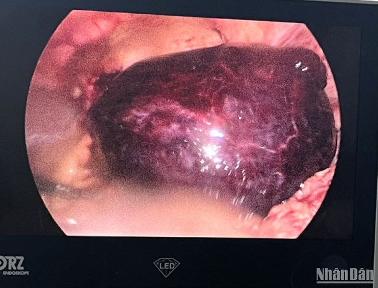 Hình ảnh u buồng trứng trái bị xoắn đã hoại tử khi nội soi ổ bụng.