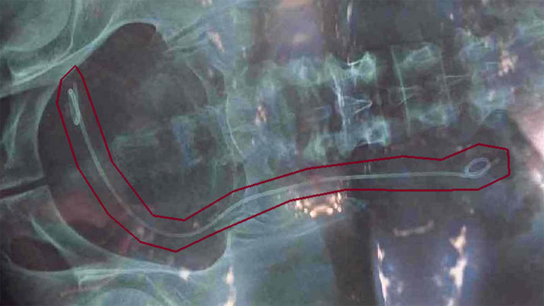 Kết quả X-quang của bệnh nhân H. bị nhầm lẫn với bệnh nhân khác. Kết quả X-quang của bệnh nhân H. bị nhầm lẫn với bệnh nhân khác.