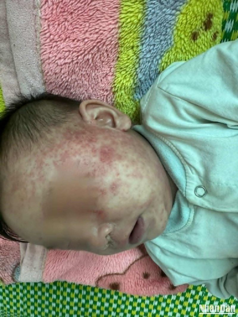 Một trẻ em bị bệnh sởi đang được điều trị tại Bệnh viện Nhi Thái Bình.