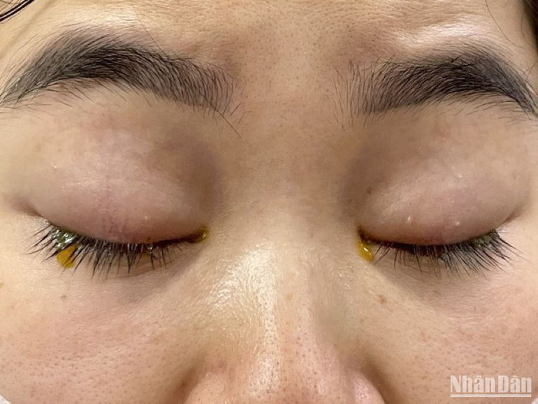 Đau mắt đỏ là bệnh về mắt thường gặp với những biểu hiện đặc trưng ngứa, đỏ mắt, cộm…