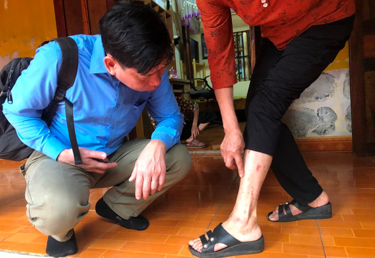 Cán bộ chuyên môn quan sát các biểu hiện mẩn, ngứa ngoài da.