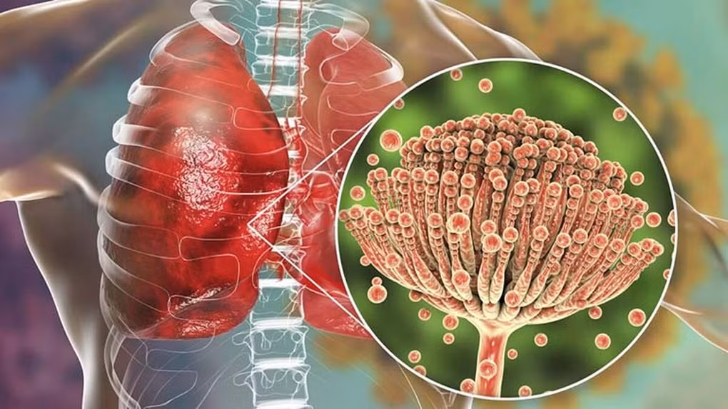 Aspergillus là một loại nấm mốc rất phổ biến, có mặt ở trong nhà và ngoài môi trường (Ảnh: Health). Aspergillus là một loại nấm mốc rất phổ biến, có mặt ở trong nhà và ngoài môi trường (Ảnh: Health).