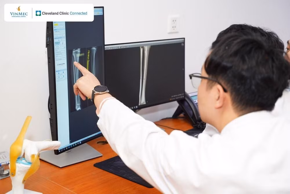 Kết quả hội chẩn ghi nhận: Xuân Son bị gãy kín phức tạp 1/3 giữa thân hai xương cẳng chân, có mảnh rời lớn. Kết quả hội chẩn ghi nhận: Xuân Son bị gãy kín phức tạp 1/3 giữa thân hai xương cẳng chân, có mảnh rời lớn.