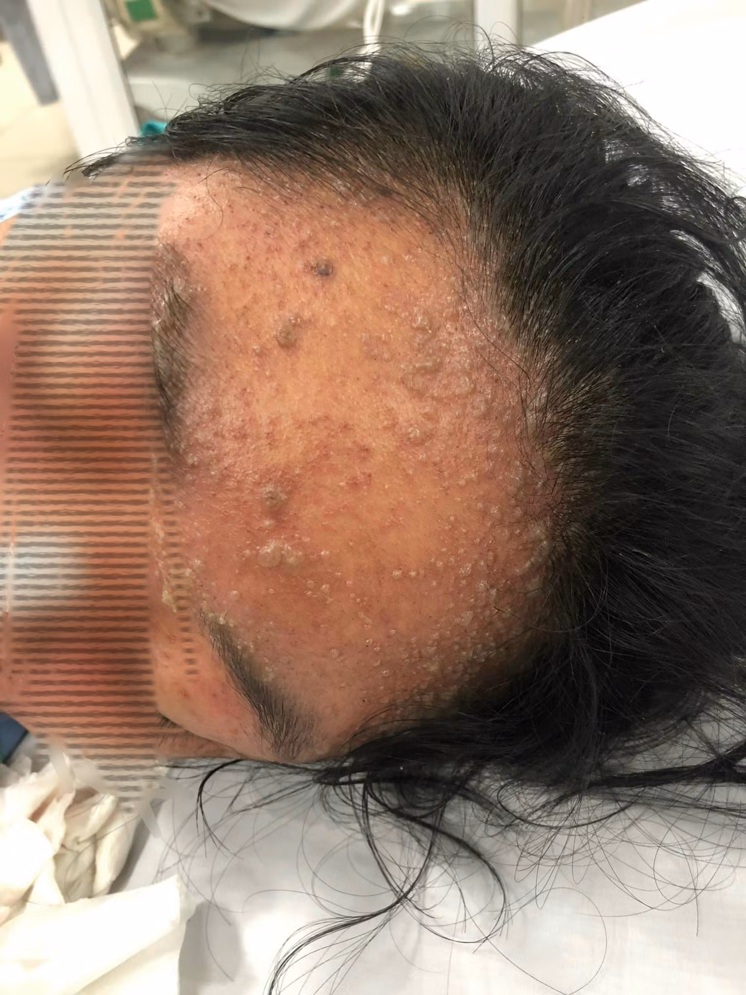 Bệnh nhân bị bội nhiễm nặng nề do mắc thủy đậu. Bệnh nhân bị bội nhiễm nặng nề do mắc thủy đậu.