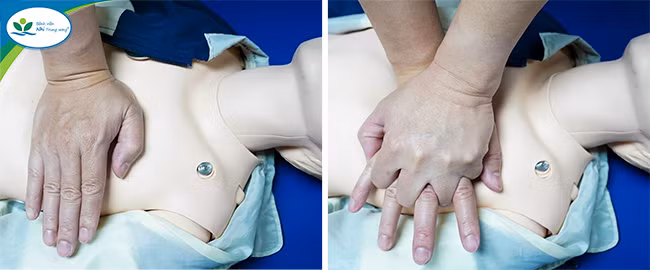 Ép tim ngoài lồng ngực. Ép tim ngoài lồng ngực.