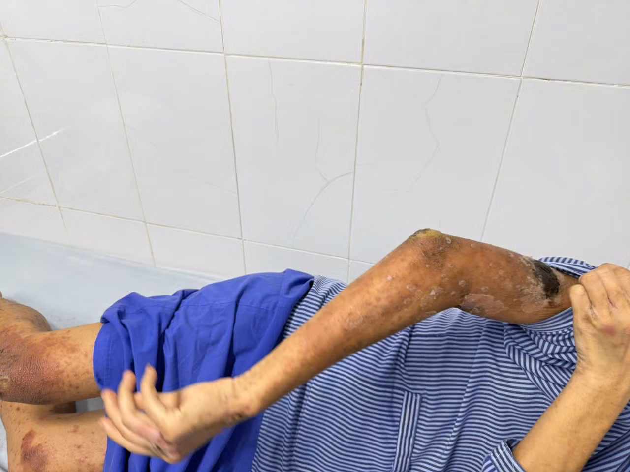 Bệnh nhân nhiễm trùng toàn thân. Bệnh nhân nhiễm trùng toàn thân.