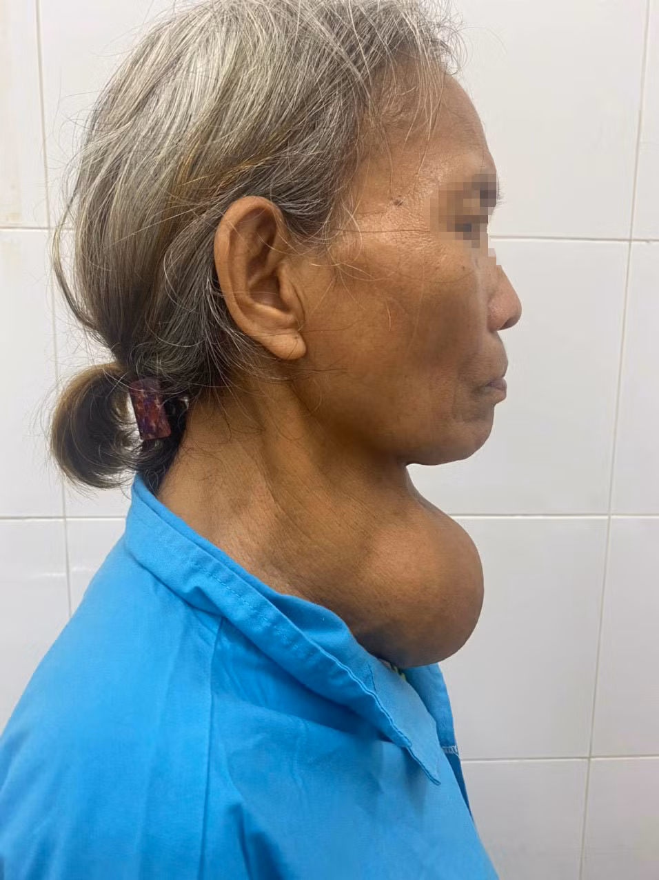 Hình ảnh khối u tuyến giáp trên cổ bệnh nhân trước phẫu thuật.