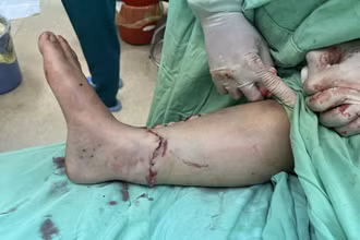 Ca phẫu thuật kéo dài 5 giờ nối thành công bàn chân bị đứt rời cho bệnh nhân P.T.P bị tai nạn giao thông.