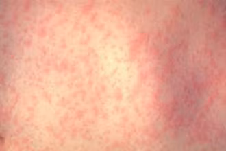 Bùng phát dịch sởi tại Mỹ, CDC ban bố cảnh báo đi lại