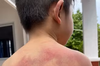 Cháu Đ bị nhiều vết bầm tím trên cơ thể do cha đánh.
