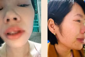 Cô giáo Vũ Thị Kim Q bị phụ huynh học sinh đến tận nhà riêng hành hung.