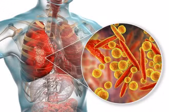 Viêm phổi do mycoplasma là một bệnh nhiễm trùng ở phổi khá phổ biến.
