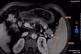 Kết quả chụp MRI của bệnh nhân nghiện rượu cho thấy hình ảnh xơ gan lách to, dịch bao quanh gan. (Ảnh: BVCC)
