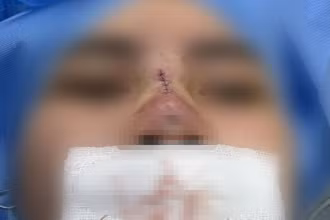 Bệnh nhân bị hoại tử mũi sau nâng mũi căng chỉ ở một cơ sở thẩm mỹ không uy tín.
