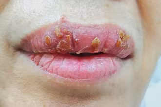 Nhiễm trùng môi vì làm đẹp cấp tốc 