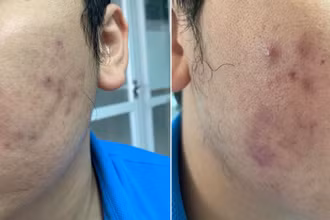 Bệnh nhân gặp biến chứng sau khi tiêm meso để làm đẹp.