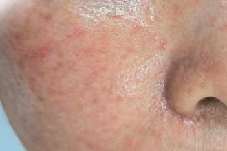 Một trường hợp bị mẩn đỏ li ti sau tự peel da tại nhà.