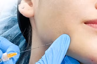 Bác sĩ tiêm filler điều chỉnh đường nét cằm và hàm cho bệnh nhân.