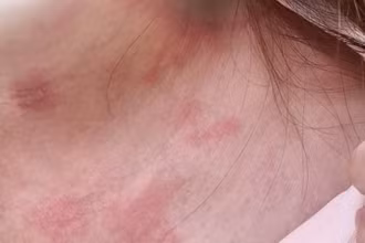 Tổn thương do kiến ba khoang. 