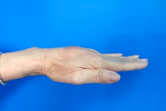 Bàn tay bị biến chứng u hạt sau khi tiêm filler tay.