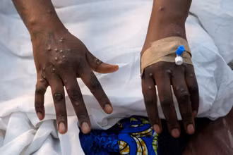 Một bệnh nhân bị phát ban trên da do vi rút đậu mùa khỉ. Ảnh: Reuters