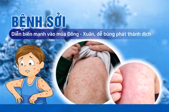 Thủ tướng Chính phủ chỉ đạo tăng cường công tác phòng, chống bệnh sởi