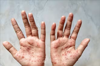 Các ban đỏ nổi trên tay một bệnh nhân mắc bệnh đậu mùa khỉ. (Ảnh: Shutterstock/TTXVN)