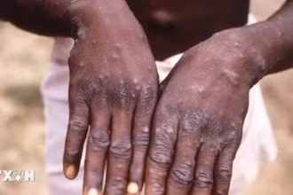 Bàn tay của bệnh nhân mắc đậu mùa khỉ tại CHDC Congo. (Ảnh: Getty Images/ TTXVN)